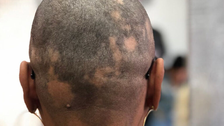 Alopecia Areata