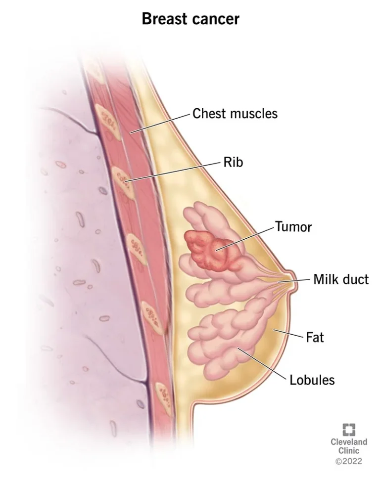 Breast cancer