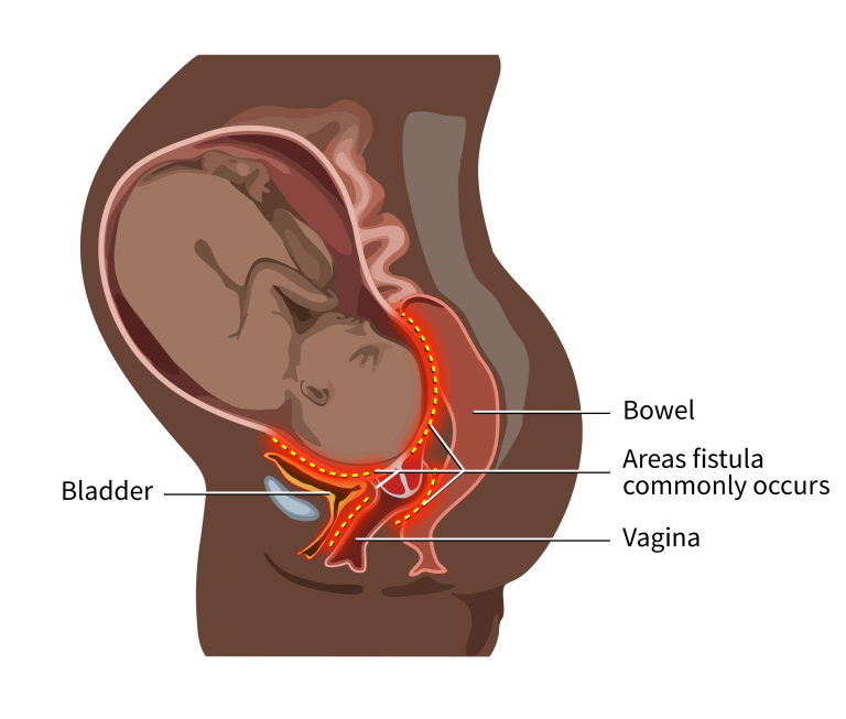 Obstetric Fistula