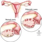 Polycystic Ovary Syndrome
