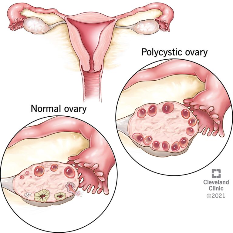 Polycystic Ovary Syndrome